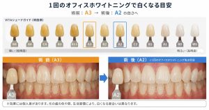 一回のホワイトニングでどのくらい白くなるのかの写真
