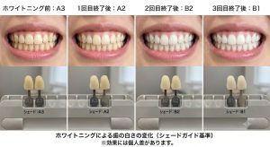 オフィスホワイトニングをしてなんかいすれば真っ白になるのか？
